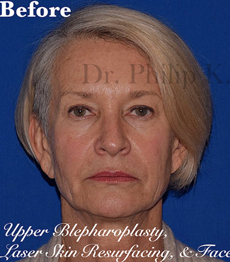 Cosmetic Non-Surgical Before & After Gallery - Patient 63360584 - Image 1