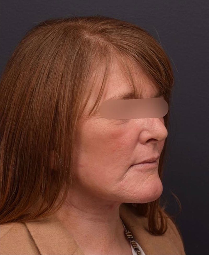 Face Before & After Gallery - Patient 63360581 - Image 4