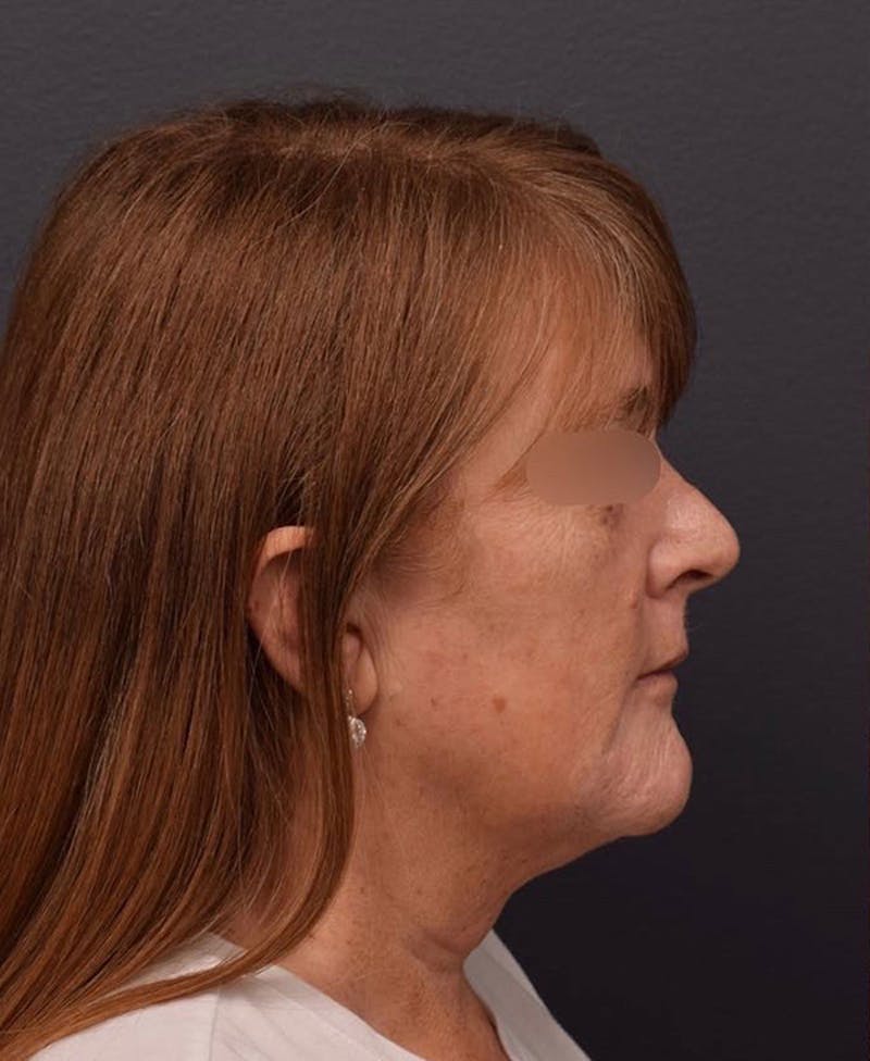 Face Before & After Gallery - Patient 63360581 - Image 5
