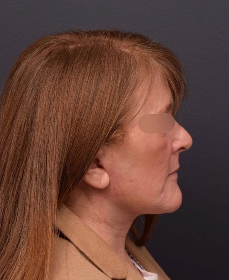 Face Before & After Gallery - Patient 63360581 - Image 6