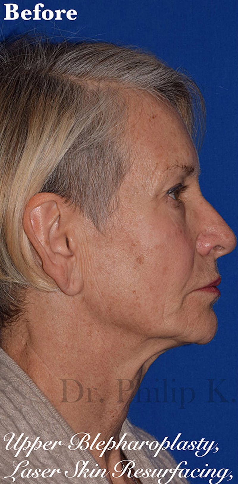 Cosmetic Non-Surgical Before & After Gallery - Patient 63360584 - Image 5