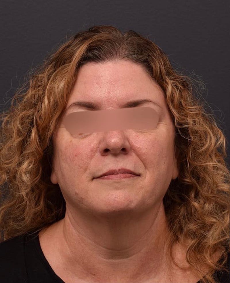 Face Before & After Gallery - Patient 63360592 - Image 1