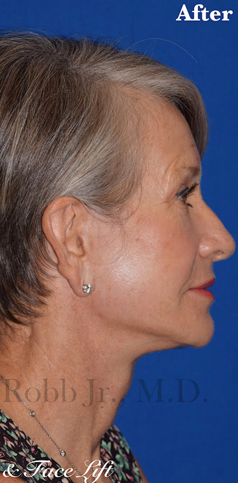 Non-Surgical Before & After Gallery - Patient 63360584 - Image 6