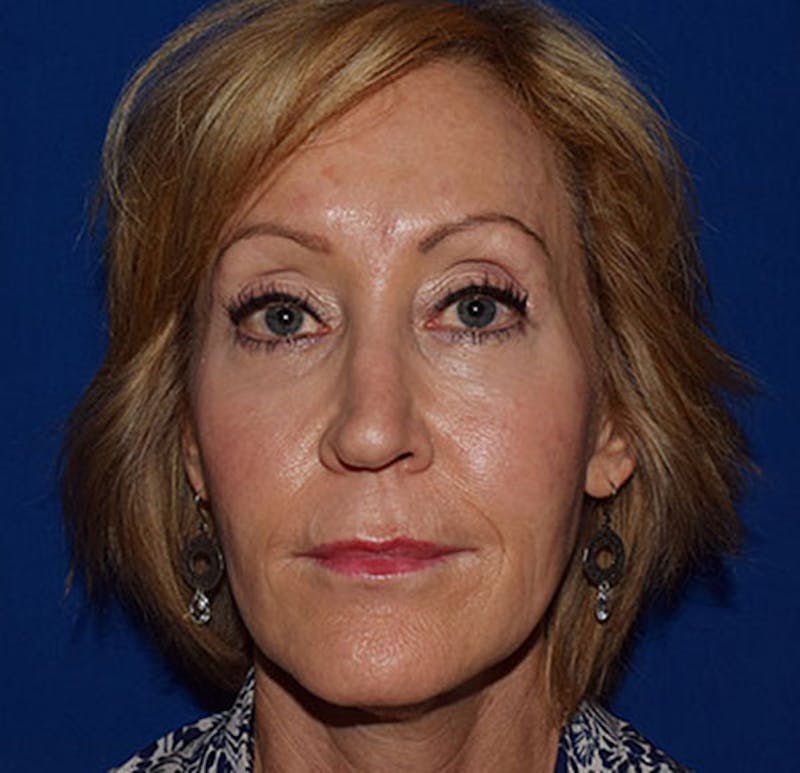 Face Before & After Gallery - Patient 419710 - Image 1