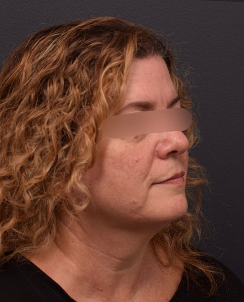 Face Before & After Gallery - Patient 63360592 - Image 3