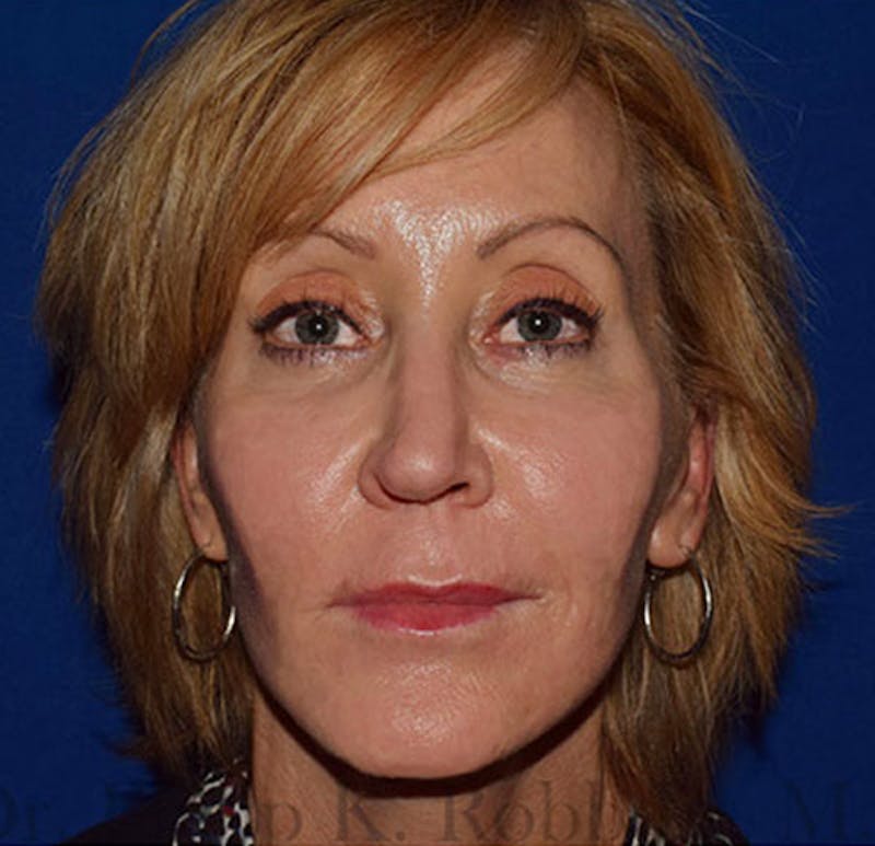 Face Before & After Gallery - Patient 419710 - Image 2
