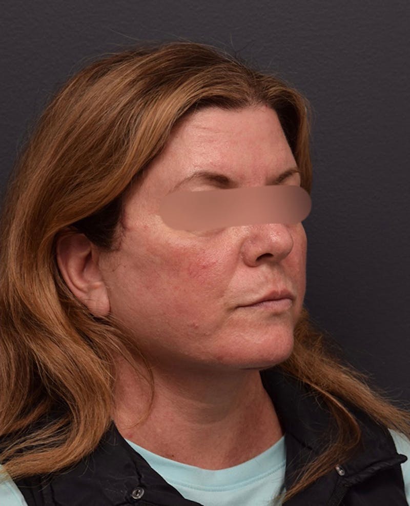 Face Before & After Gallery - Patient 63360592 - Image 4