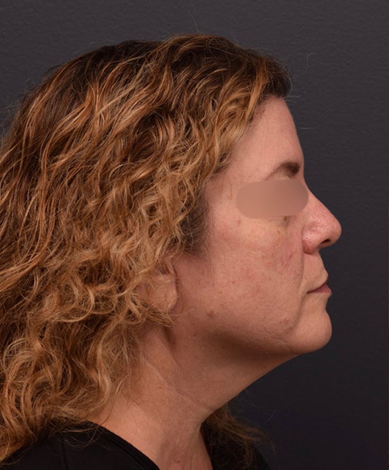 Face Before & After Gallery - Patient 63360592 - Image 5