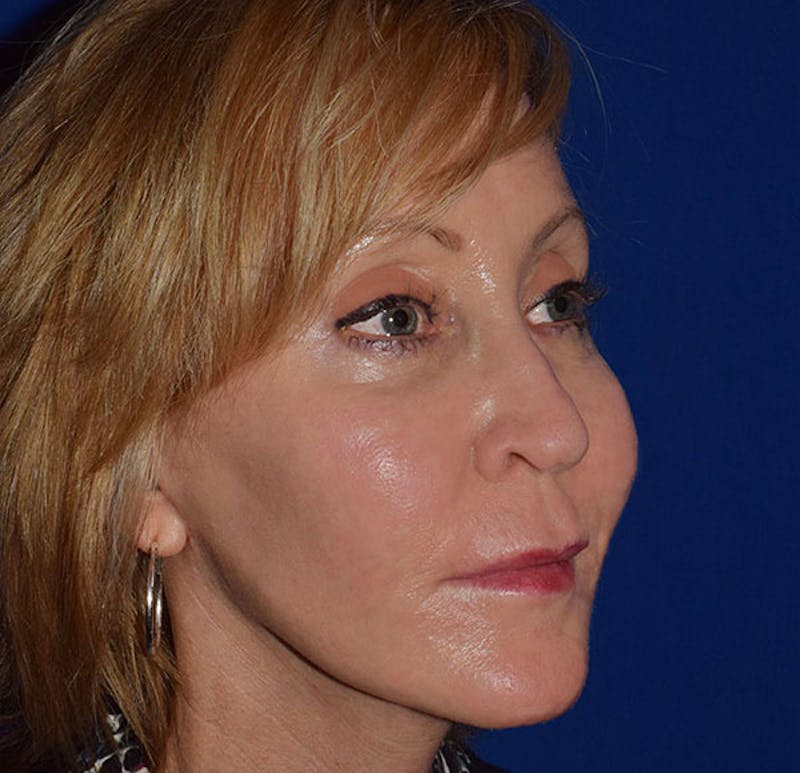 Face Before & After Gallery - Patient 419710 - Image 4