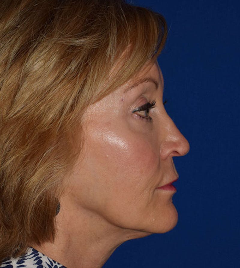 Face Before & After Gallery - Patient 419710 - Image 5