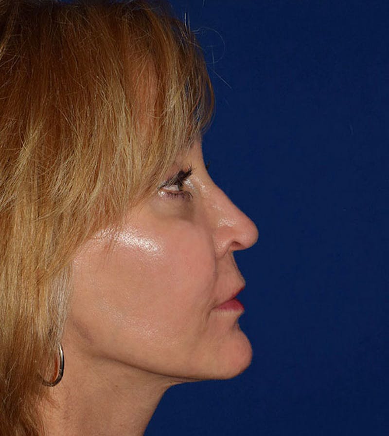 Face Before & After Gallery - Patient 419710 - Image 6