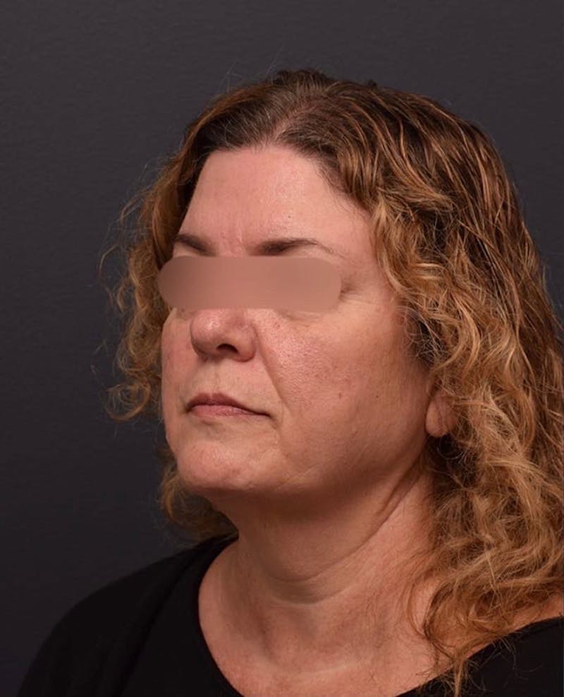 Face Before & After Gallery - Patient 63360592 - Image 7