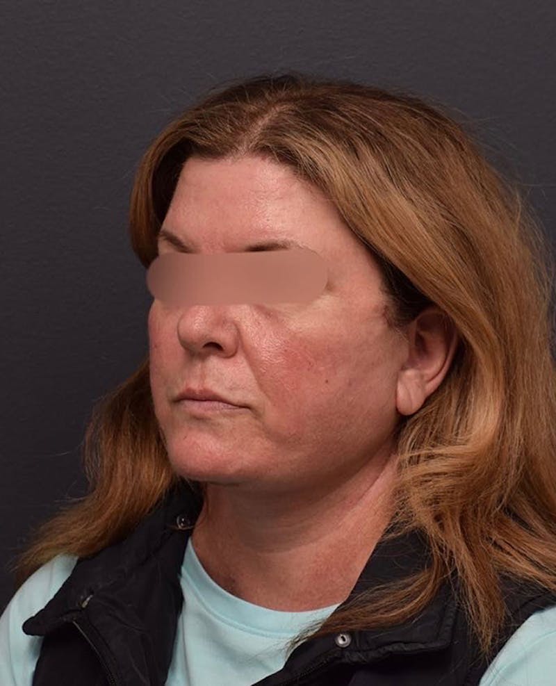 Face Before & After Gallery - Patient 63360592 - Image 8