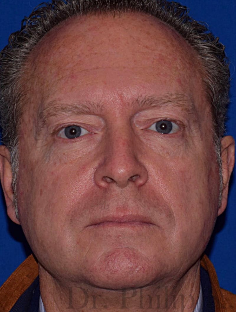 Cosmetic Non-Surgical Before & After Gallery - Patient 63360593 - Image 1