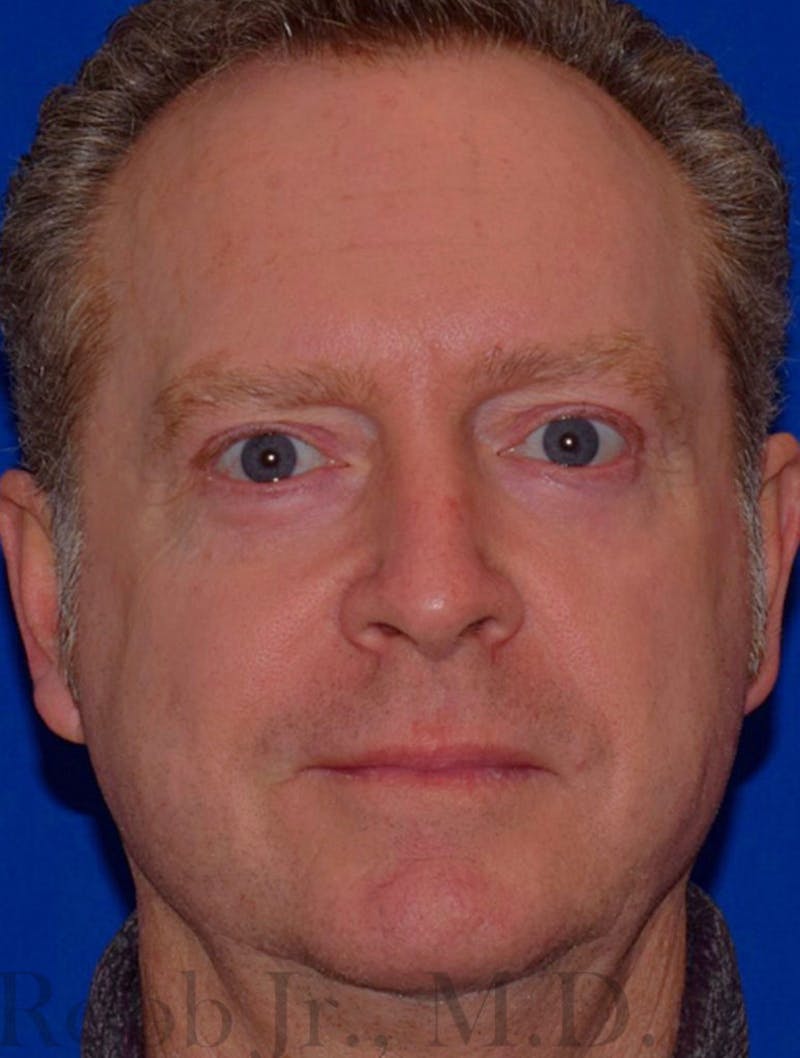 Cosmetic Non-Surgical Before & After Gallery - Patient 63360593 - Image 2