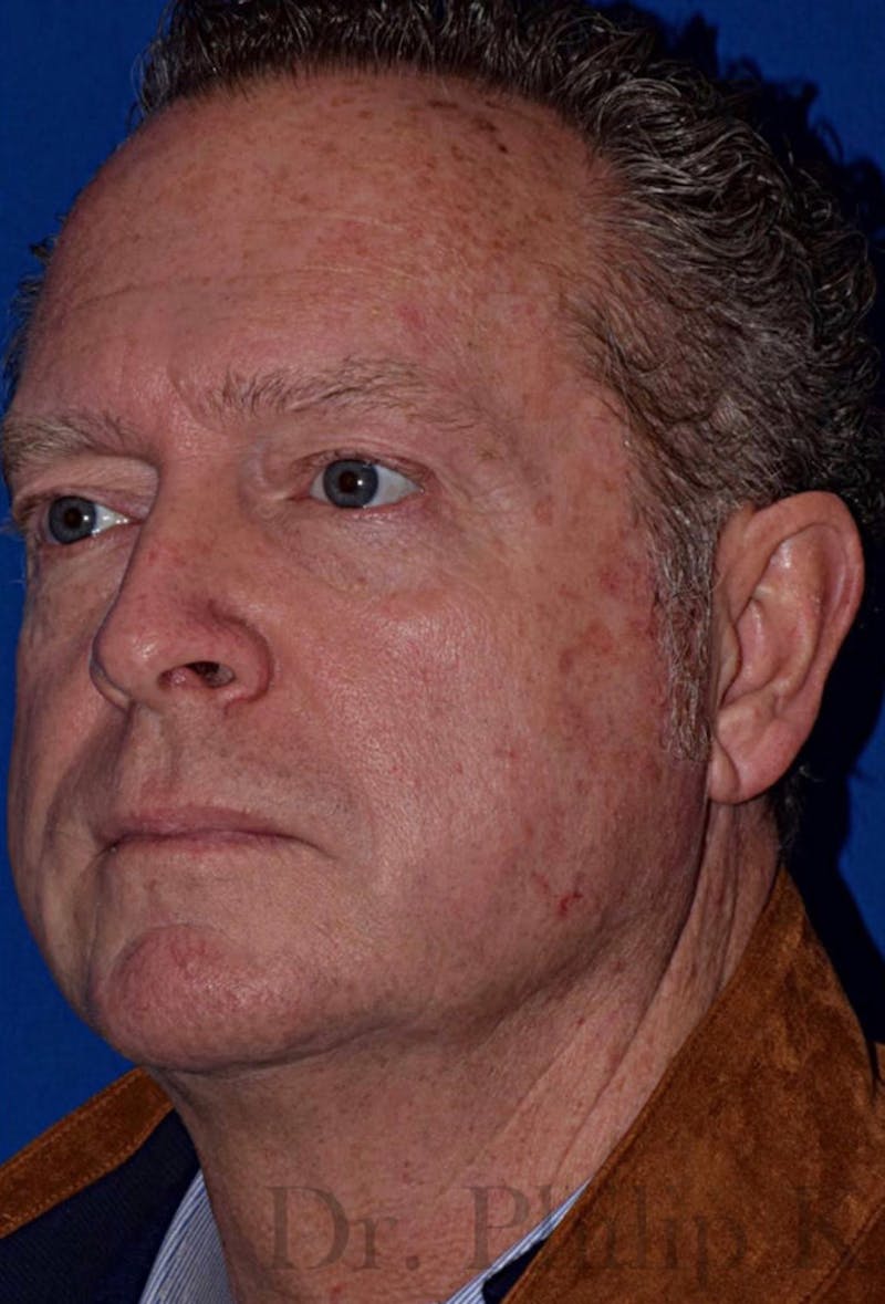 Cosmetic Non-Surgical Before & After Gallery - Patient 63360593 - Image 3