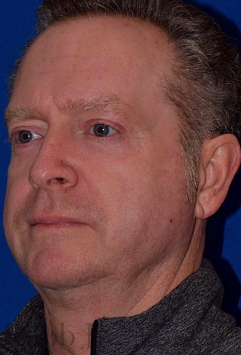 Cosmetic Non-Surgical Before & After Gallery - Patient 63360593 - Image 4