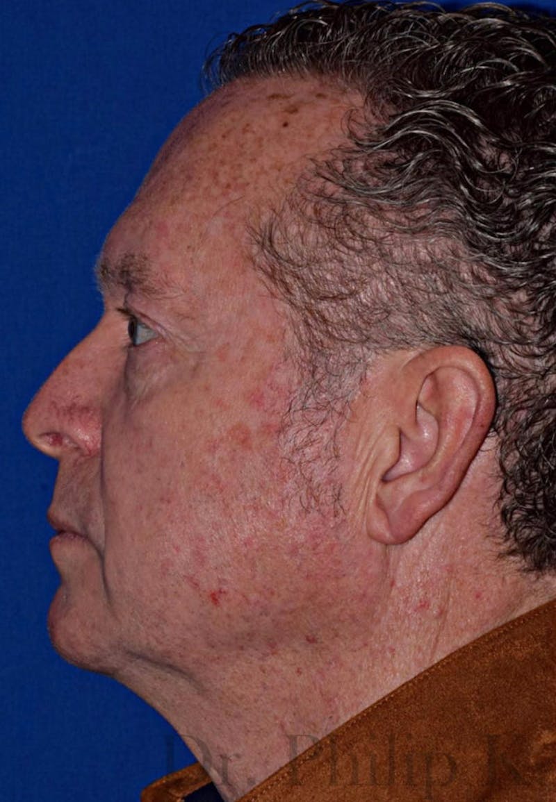 Cosmetic Non-Surgical Before & After Gallery - Patient 63360593 - Image 5