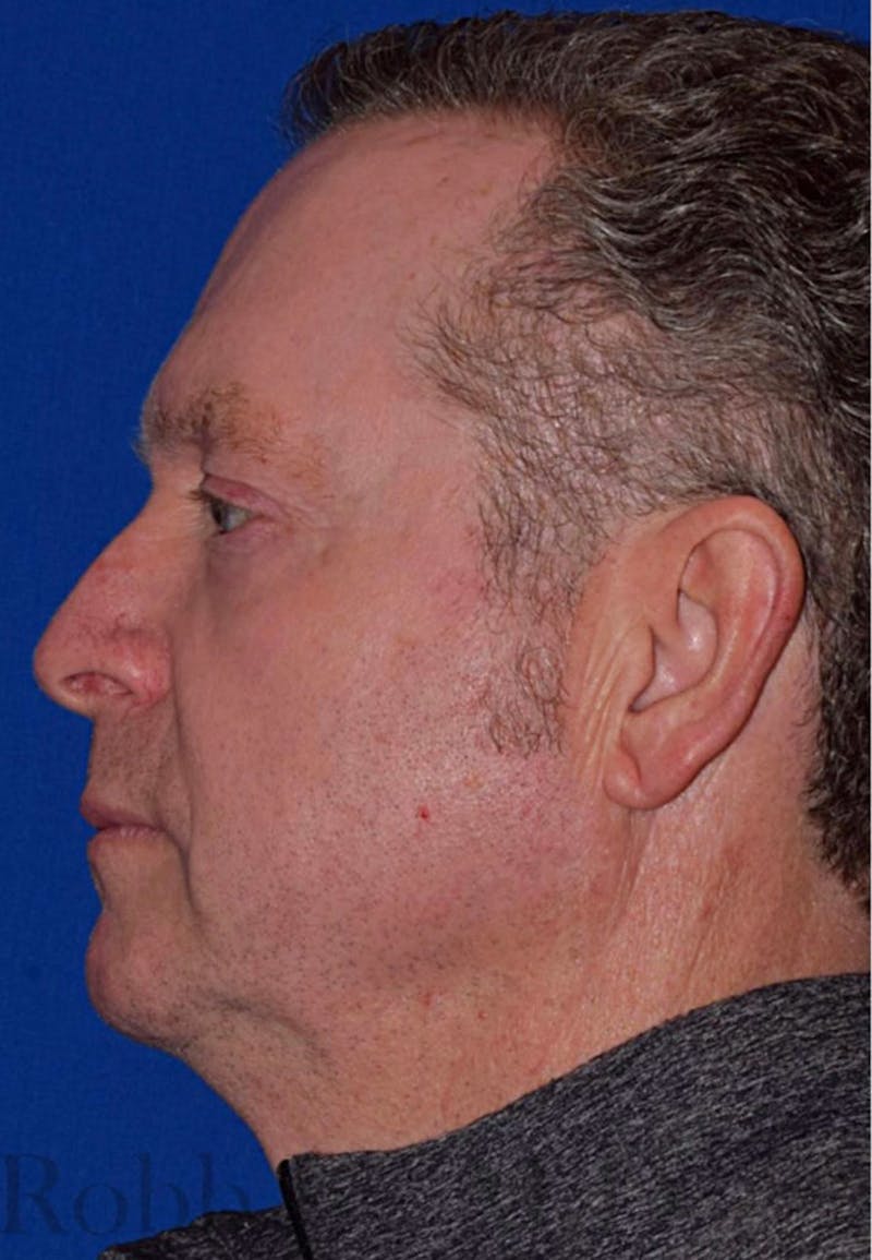 Cosmetic Non-Surgical Before & After Gallery - Patient 63360593 - Image 6