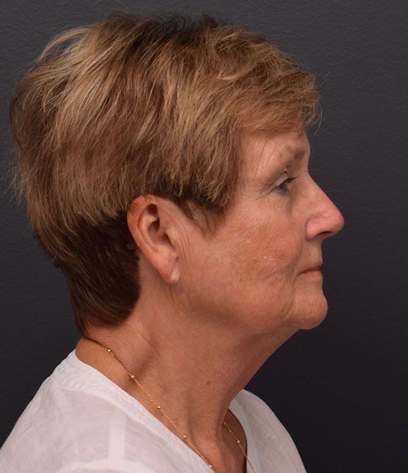 Cosmetic Surgical Before & After Gallery - Patient 63360602 - Image 5
