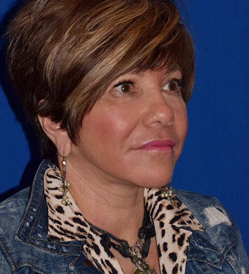 Non-Surgical Before & After Gallery - Patient 63360597 - Image 4