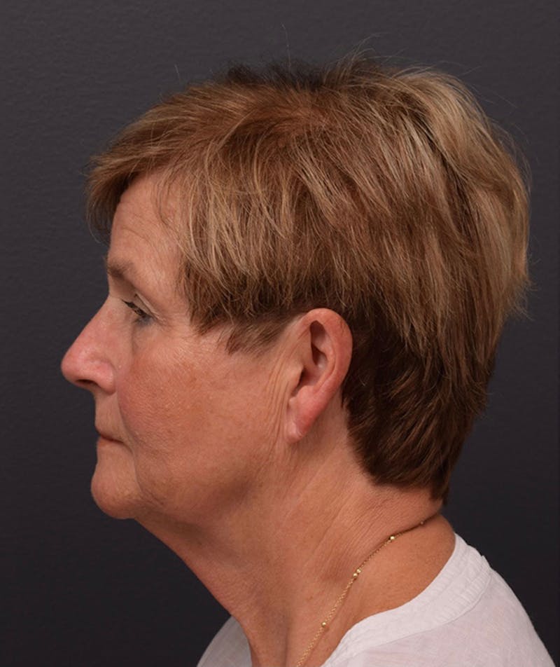 Face Before & After Gallery - Patient 63360602 - Image 9