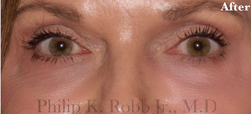 Cosmetic Non-Surgical Before & After Gallery - Patient 63360601 - Image 2