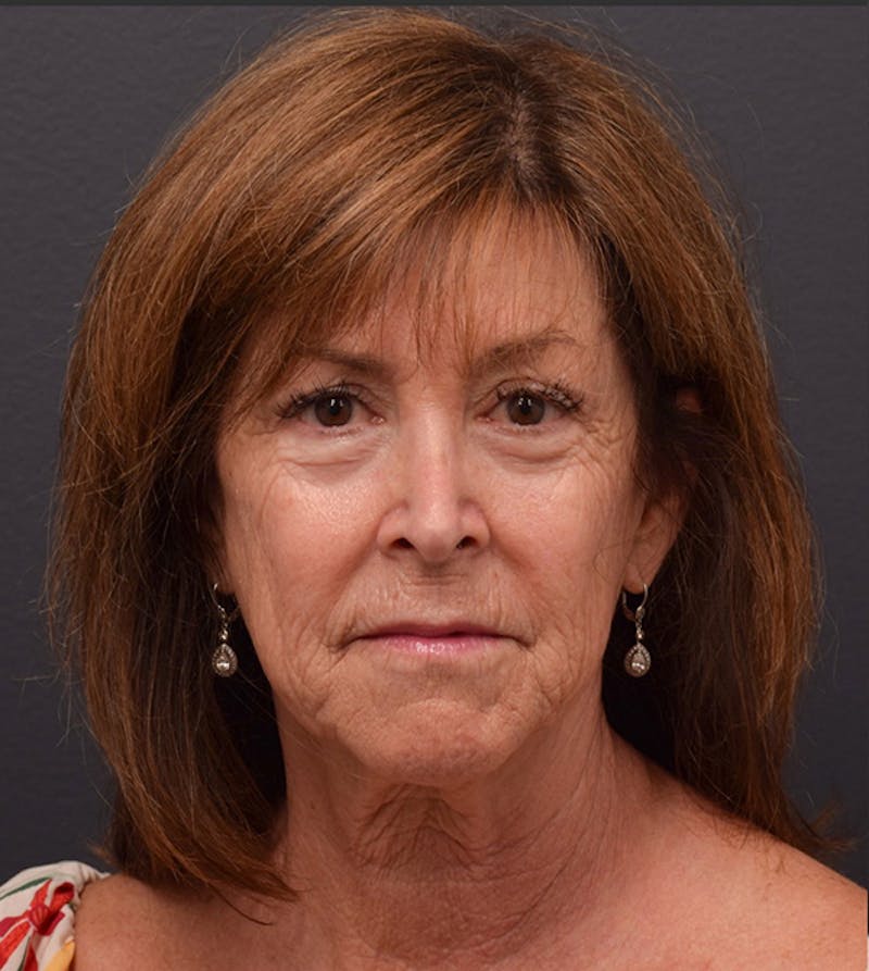 Face Before & After Gallery - Patient 63360607 - Image 1