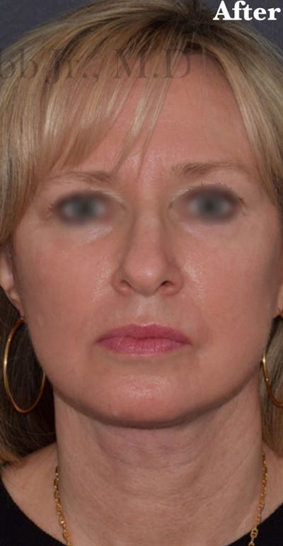 Non-Surgical Before & After Gallery - Patient 63360604 - Image 2