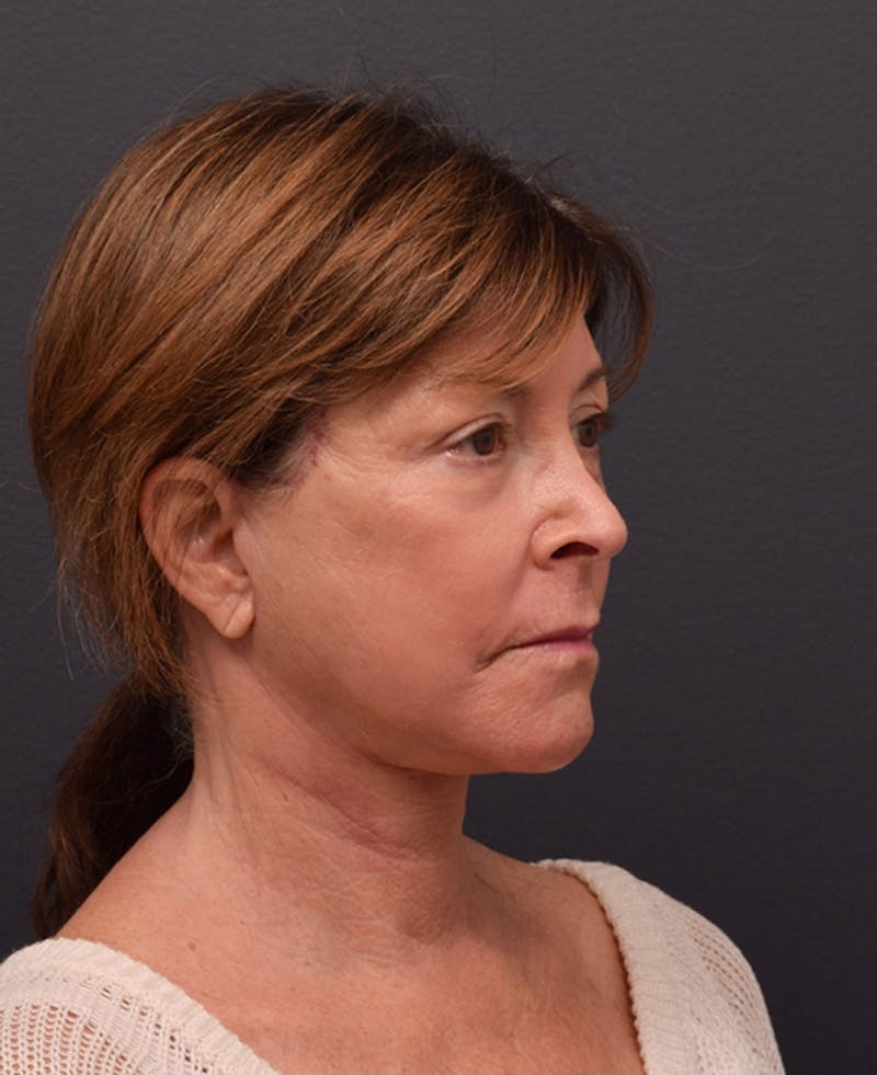 Face Before & After Gallery - Patient 63360607 - Image 4
