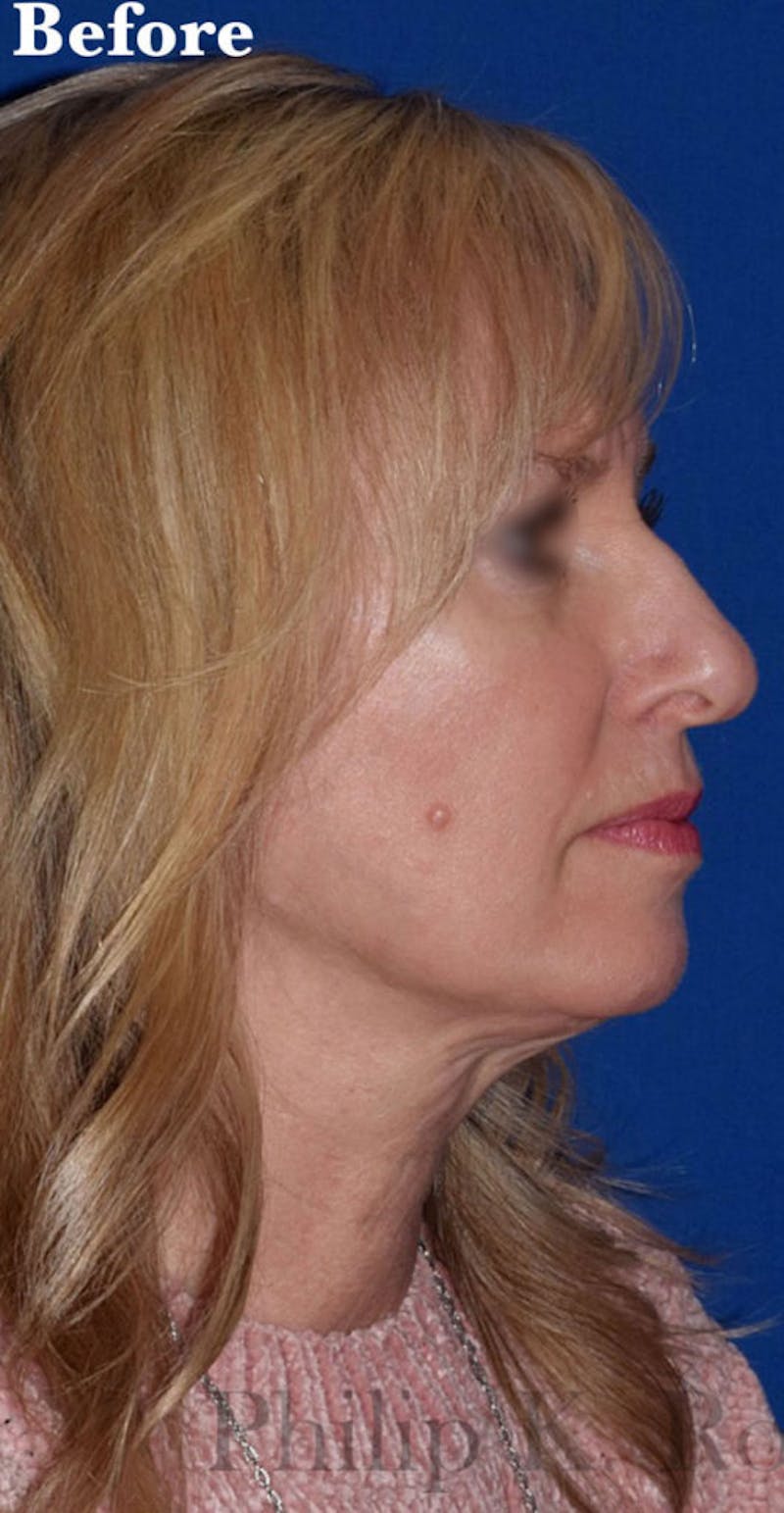 Cosmetic Non-Surgical Before & After Gallery - Patient 63360604 - Image 5