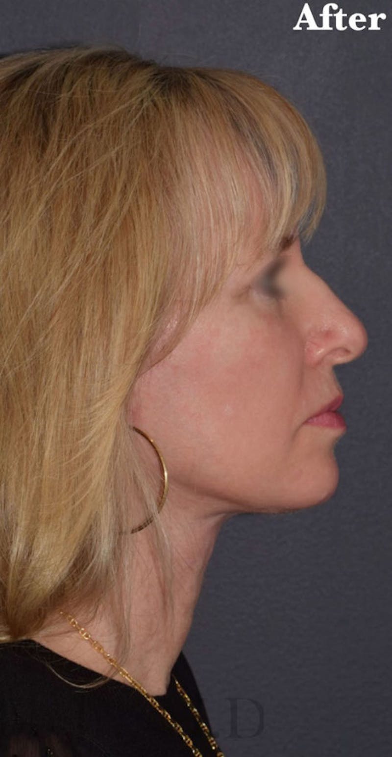 Cosmetic Non-Surgical Before & After Gallery - Patient 63360604 - Image 6