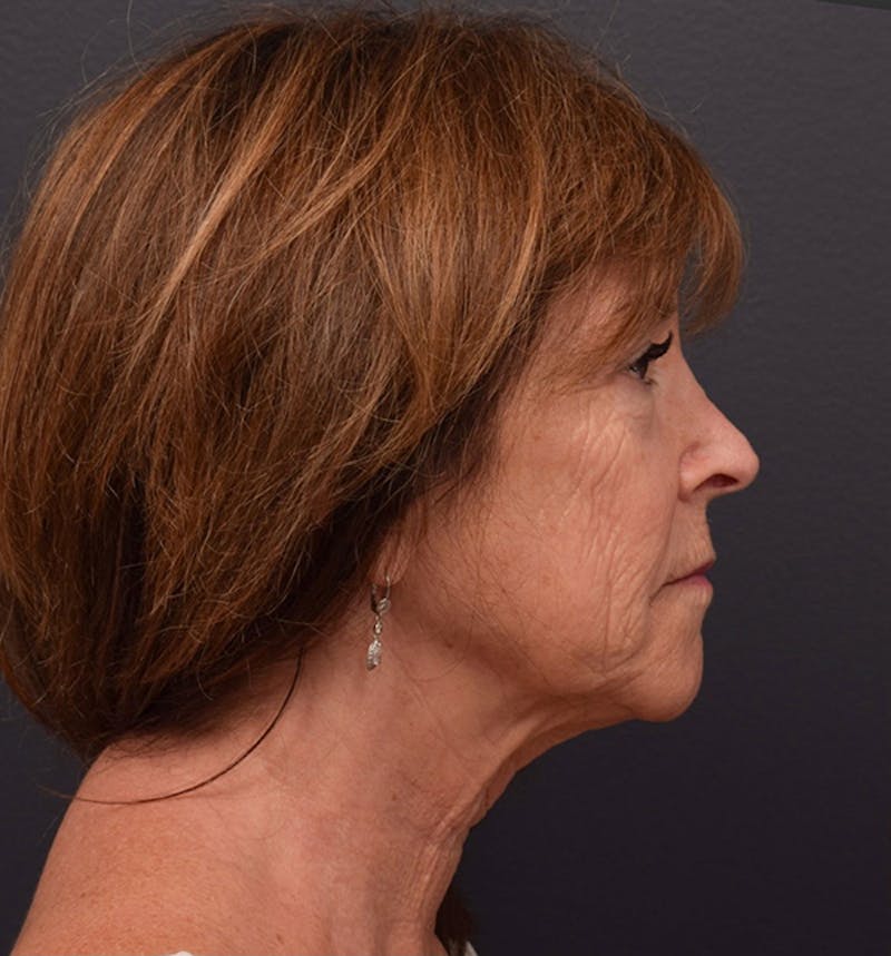 Face Before & After Gallery - Patient 63360607 - Image 5