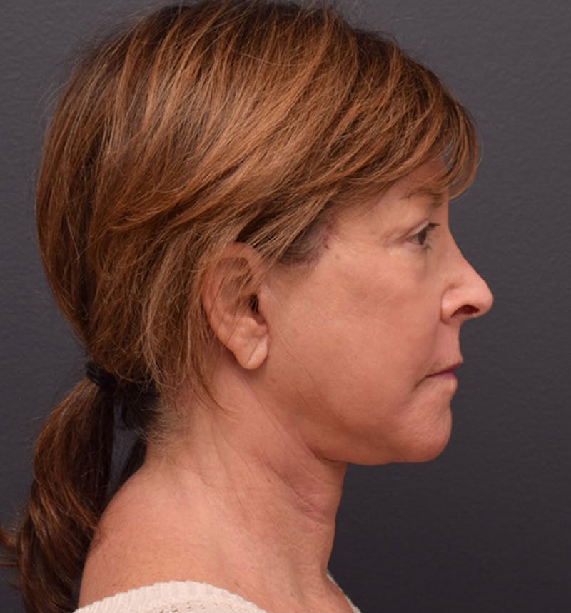 Face Before & After Gallery - Patient 63360607 - Image 6
