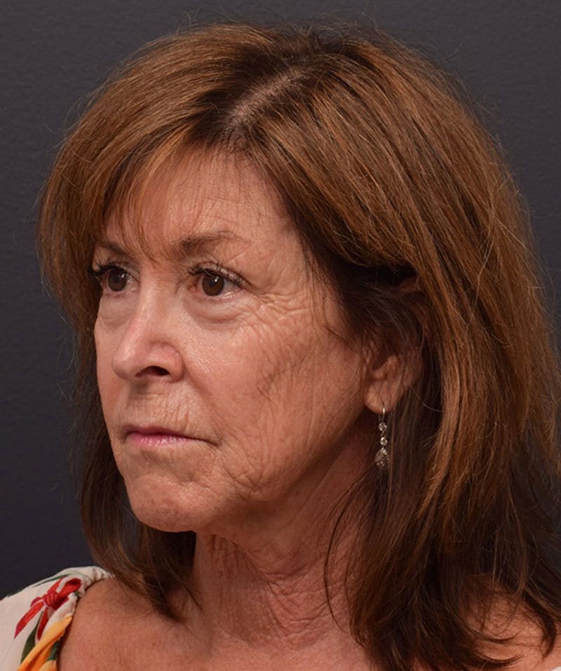 Face Before & After Gallery - Patient 63360607 - Image 7