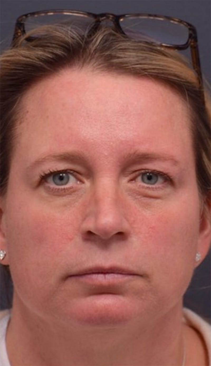 Cosmetic Non-Surgical Before & After Gallery - Patient 63360606 - Image 1