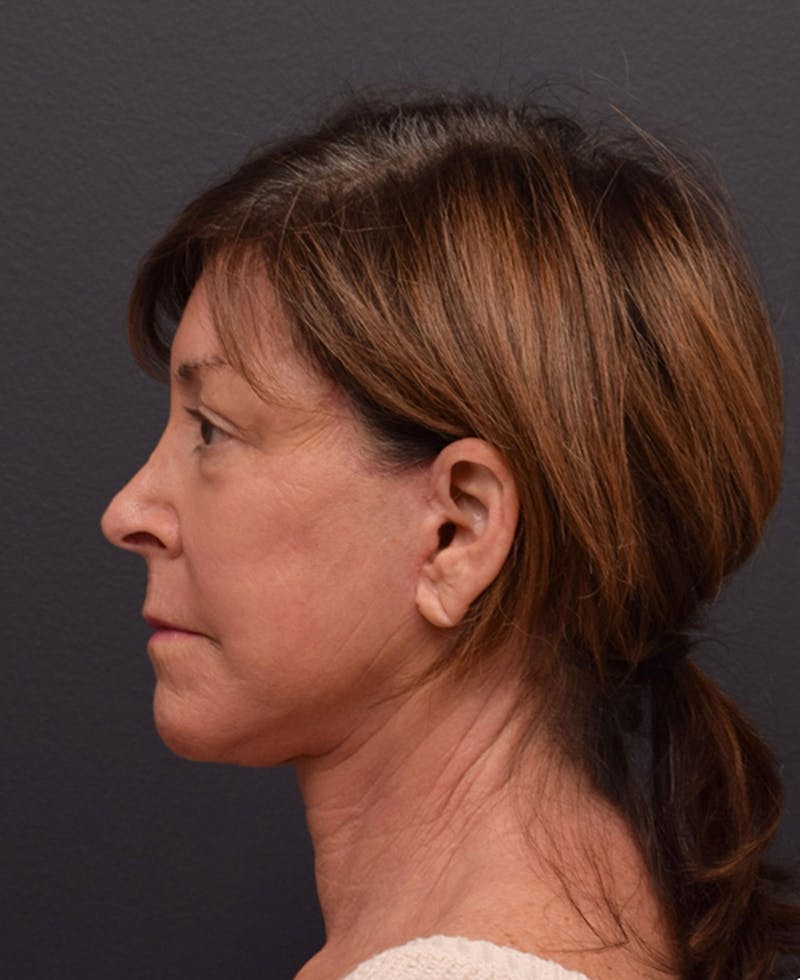 Face Before & After Gallery - Patient 63360607 - Image 10
