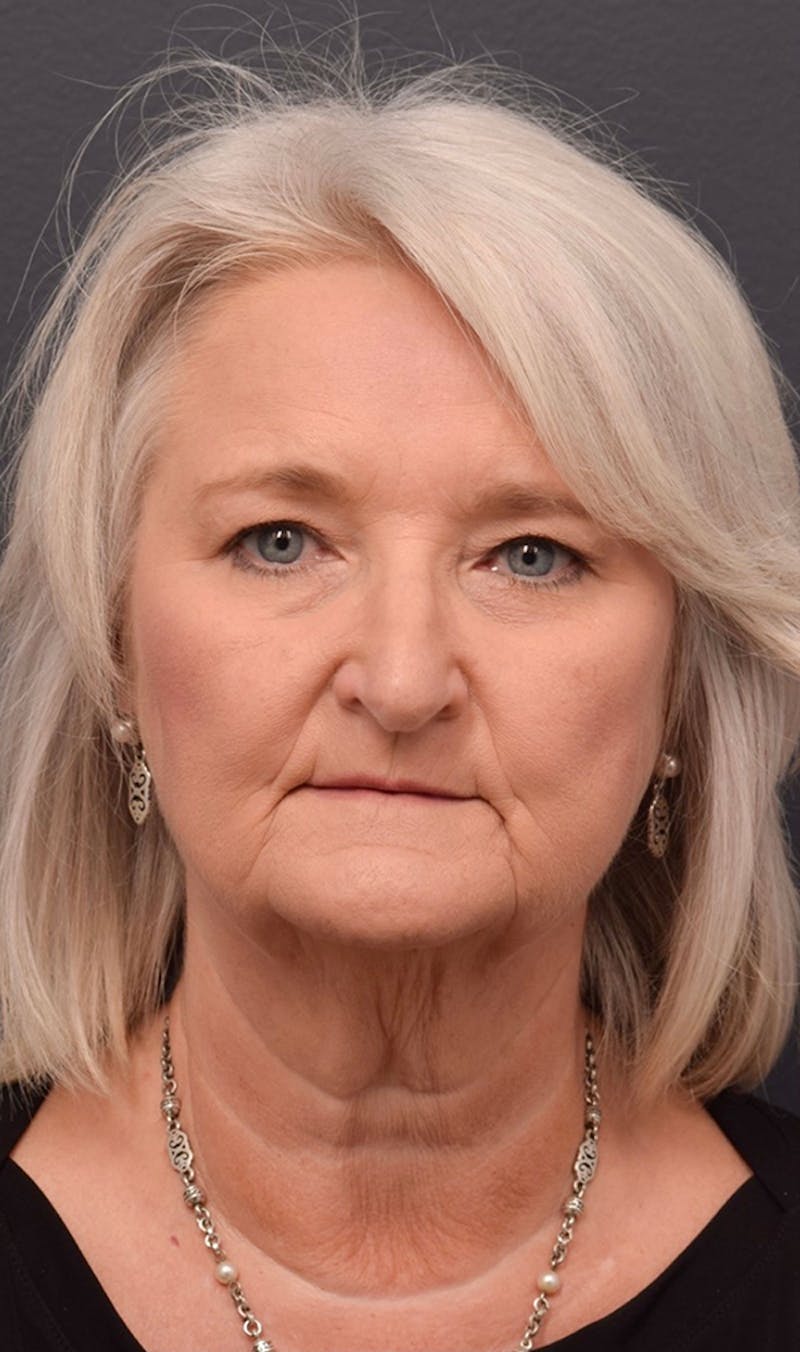 Face Before & After Gallery - Patient 63360612 - Image 1