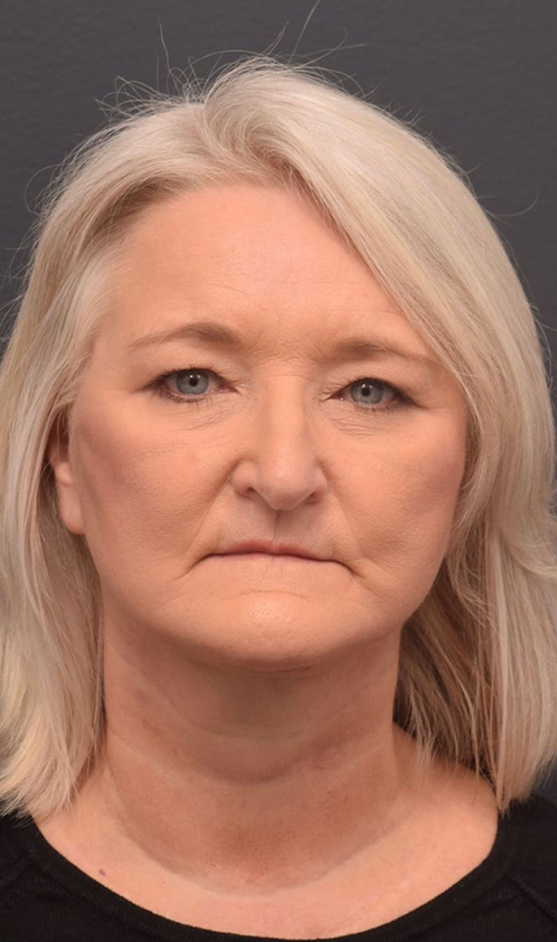 Face Before & After Gallery - Patient 63360612 - Image 2