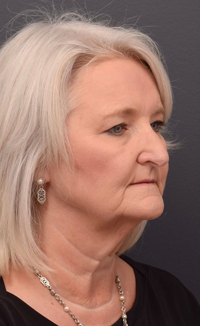 Face Before & After Gallery - Patient 63360612 - Image 3