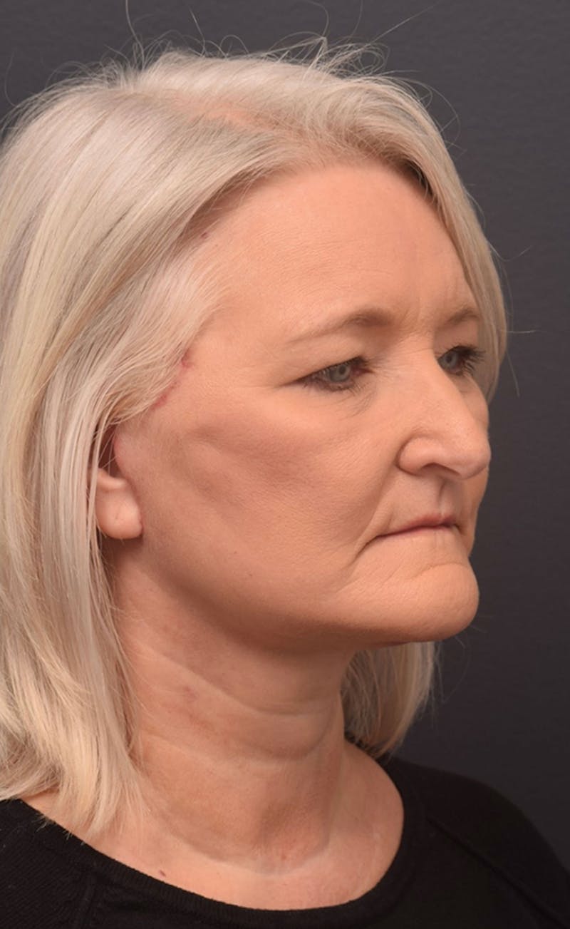 Cosmetic Surgical Before & After Gallery - Patient 63360612 - Image 4