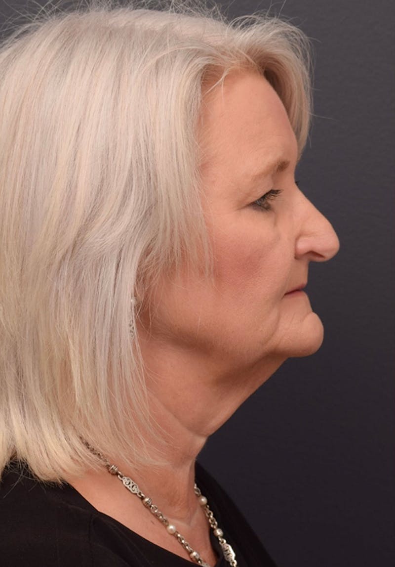 Cosmetic Surgical Before & After Gallery - Patient 63360612 - Image 5