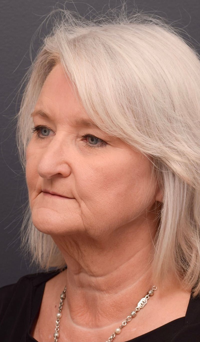 Face Before & After Gallery - Patient 63360612 - Image 7
