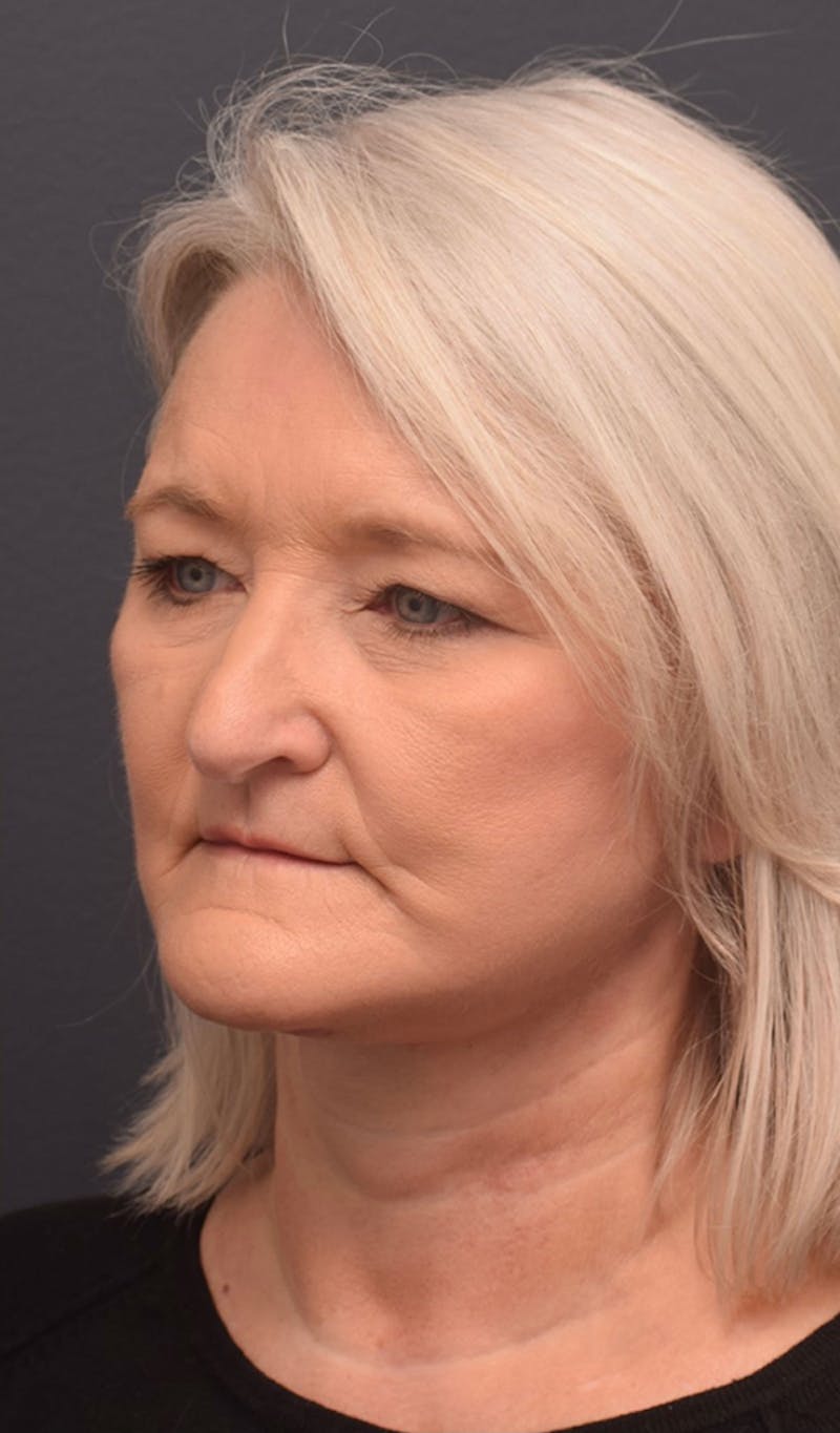 Face Before & After Gallery - Patient 63360612 - Image 8