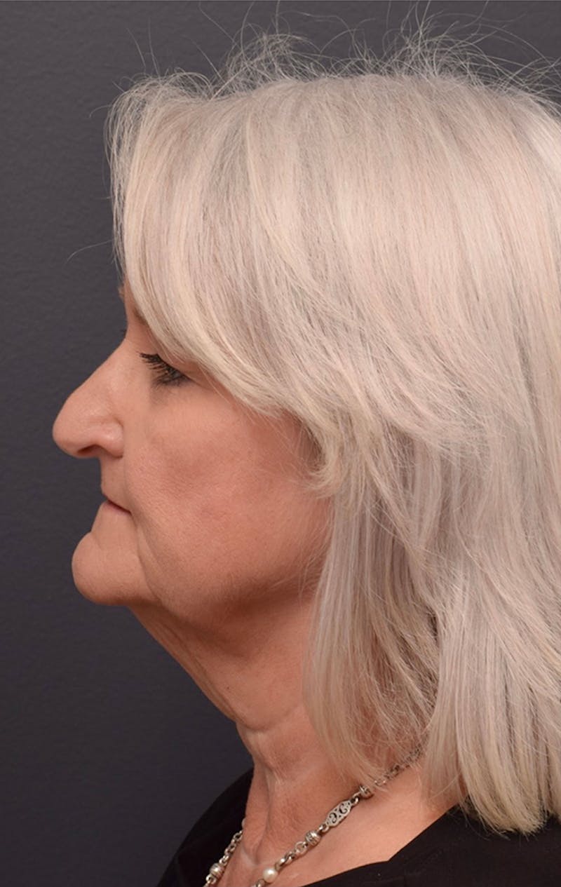 Face Before & After Gallery - Patient 63360612 - Image 9
