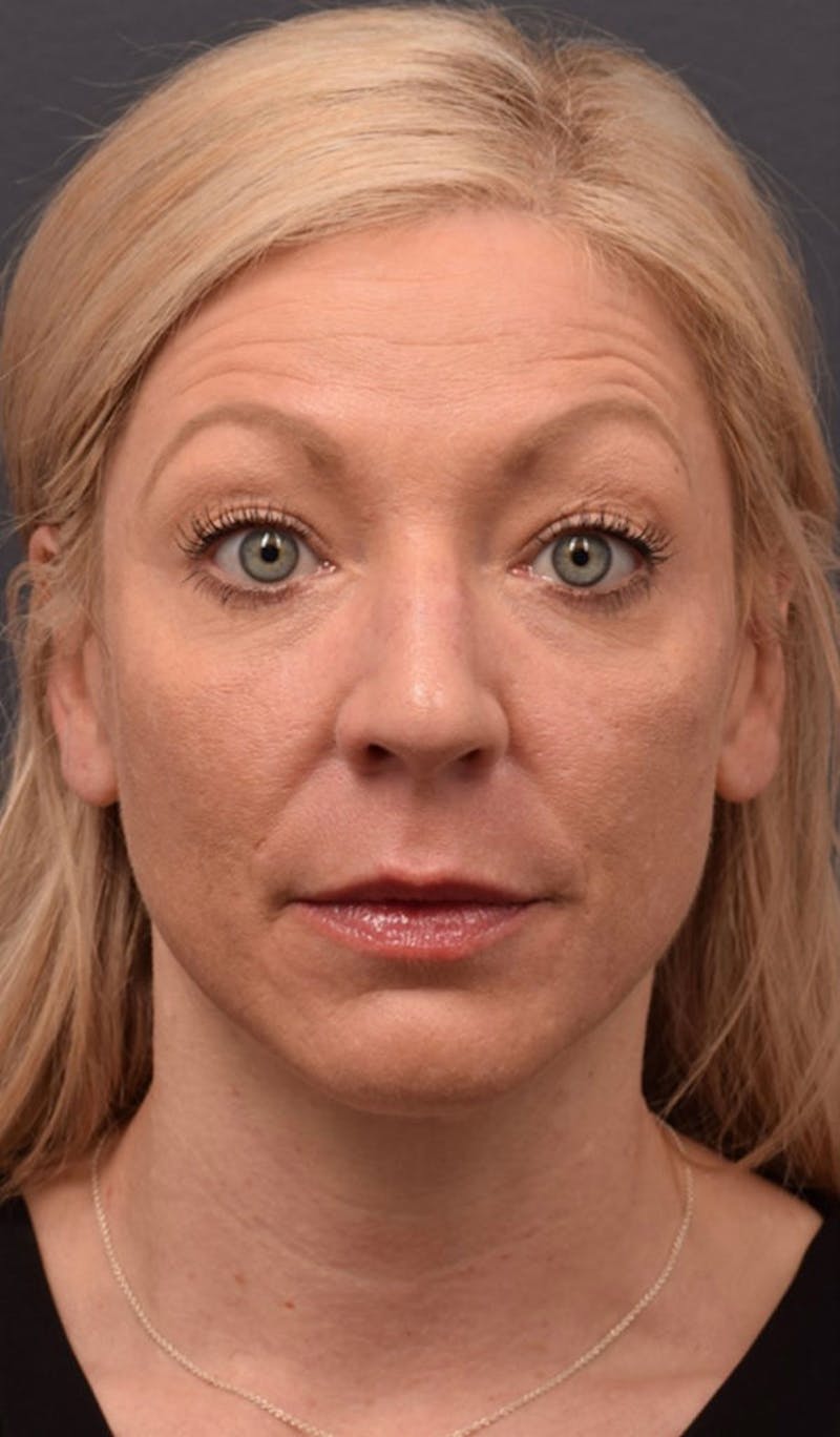 Face Before & After Gallery - Patient 63360613 - Image 1