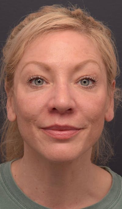 Face Before & After Gallery - Patient 63360613 - Image 2