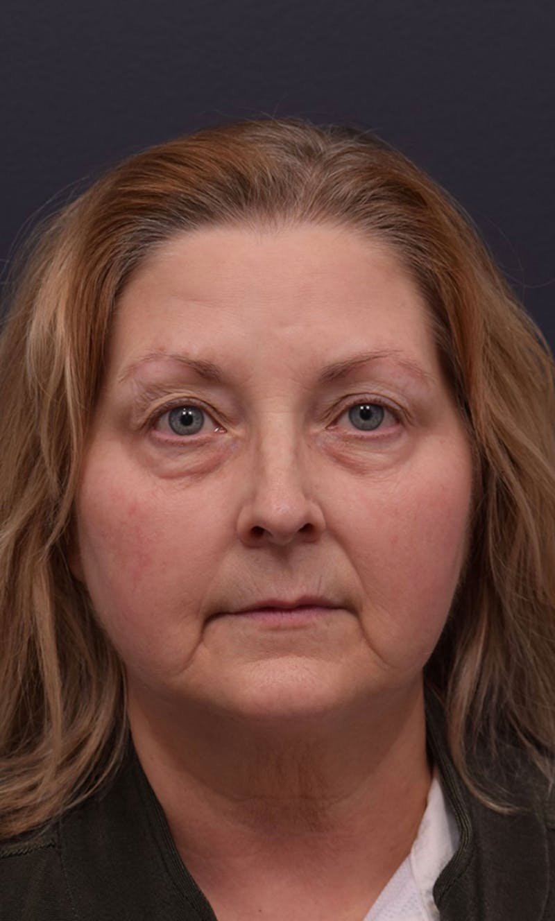 Face Before & After Gallery - Patient 63360615 - Image 1