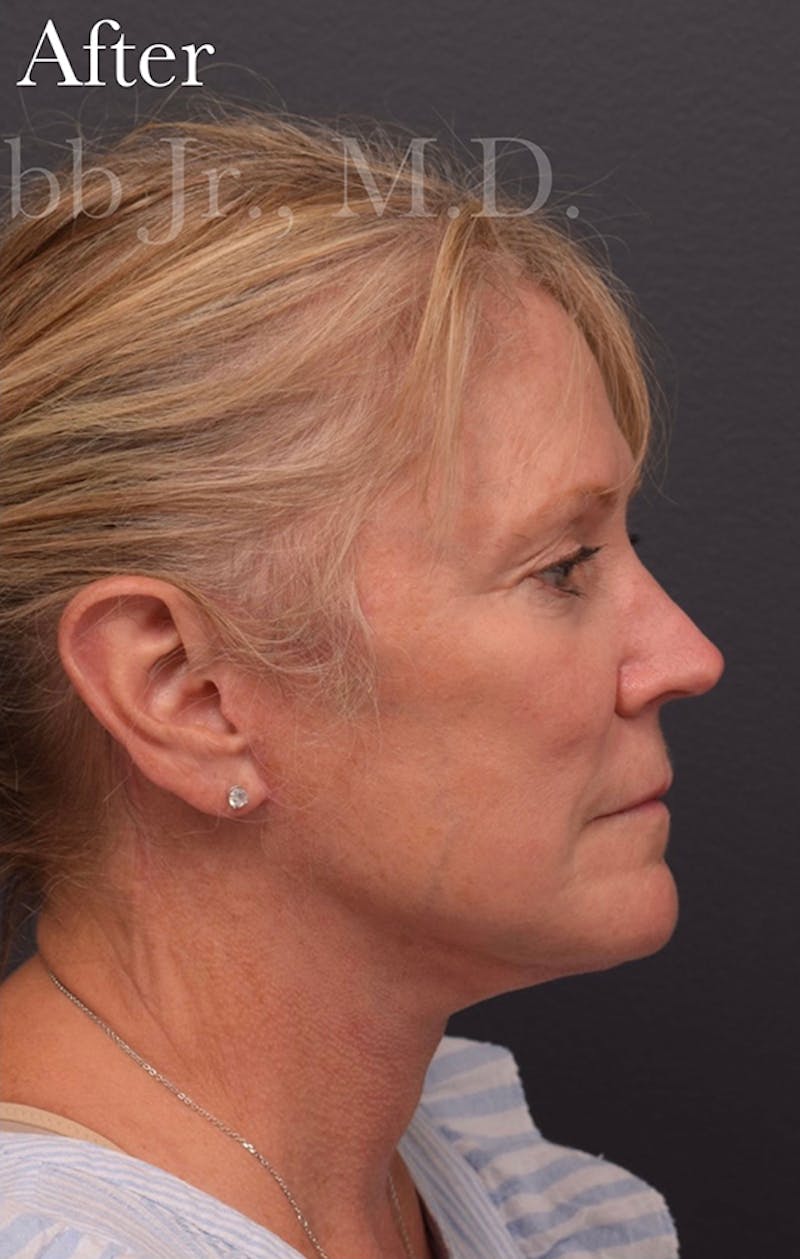 Cosmetic Non-Surgical Before & After Gallery - Patient 63360617 - Image 6