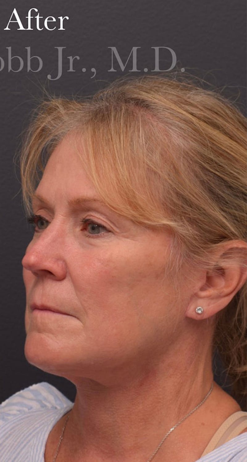Non-Surgical Before & After Gallery - Patient 63360617 - Image 8